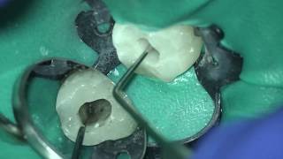 Case 3: How to remove Thermalfil plastic carrier.