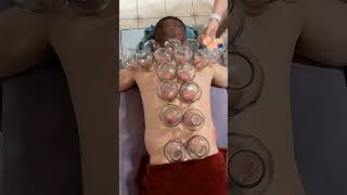 Fire 🔥 Cupping Therapy #viral #cuppingtherapy #firecupping #shorts