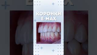 КОРОНКИ E-MAX