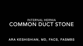 MRCP-Common Duct Stone