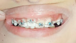 Braces of upper arch