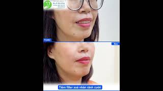 Filler xóa rãnh cười - Thay đổi diện mạo trong phút chốc - Thẩm Mỹ Khang Vĩnh