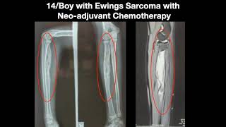 Extracorporeal radiotherapy (ECRT)  for Radius tumor : Radiation treatment for bone tumors