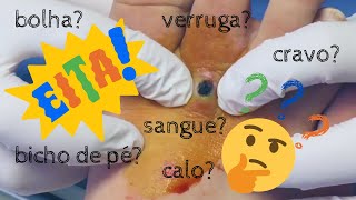 Adivinhe o que saiu deste pé?? #podologia #podiatrist #suprise