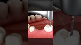 Teeth surgery 3D animation video Human body #shorts