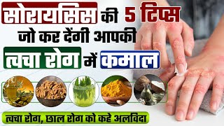 सोरायसिस बीमारी से बचने के घरेलू उपाय | Skin care | 5 चमत्कारी तरीके से करे सोरायसिस को कंट्रोल