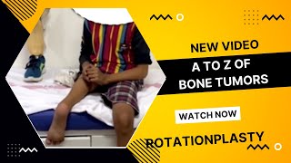 Rotationplasty or Reverse Leg surgery : Modified Amputation Surgery