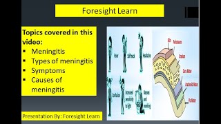 Meningitis|The Real Story Behind Meningitis|The Meningitis Guide For Everyone|