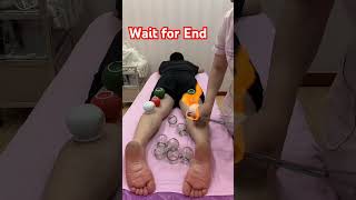 FIRE CUPPING 🔥||#viral #health #shorts#cuppingtherapy  #firecupping