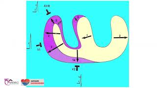 6 - Hipertrofia ventricular derecha