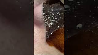 Satisfying blackheads and whiteheads removal #whiteheads #blackheads