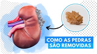 3 Métodos de Remoção de Cálculo Renal