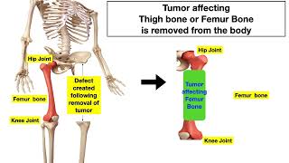 Total Femur or Thigh Bone Replacement surgery by Total Femur Megaprosthesis:Patient Education Video