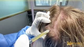 PRP Treatment For Hair Loss