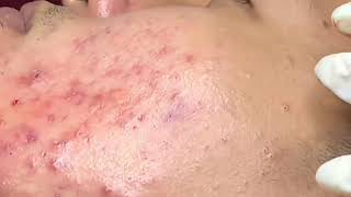 Best Acne Popping Videos