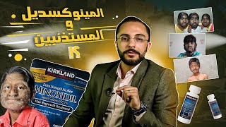 المينوكسيديل علاج تساقط الشعر وعلاقته بظهور ال ١٩ مستذئب فى أسبانيا !