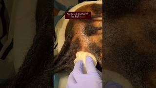 Hair Loss Due to Tight Hairstyles - Hair Transplant on Traction Alopecia