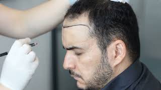 Mohamed's Hair Transplant Journey in Turkey Part 1 I Clinic International