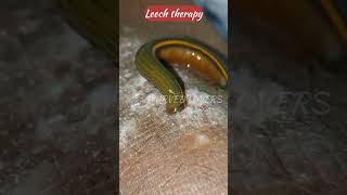 Leech therapyAyurvedic raktmokshan by leech.#ayu#ayureel#ayurvedic #leechtherapy