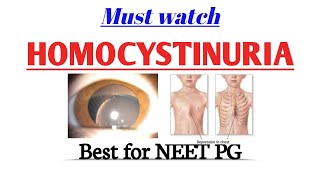 Homocystinuria || Cystathioninuria || Methionine metabolism || #biochemistry