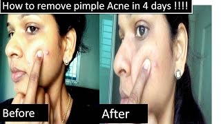 Home remedy to remove pimple in four days | With proof video |