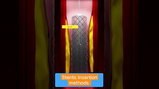 #medicalstudent #anatomy #stents #heartvideo #heartanimation #health #labtech #shortsvideo