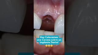 IMPLANTE DENTAL + CORONA