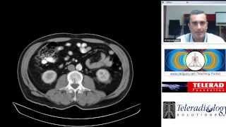 Unusual Condition of Stump Appendicitis by Dr ArjunKalyanpur