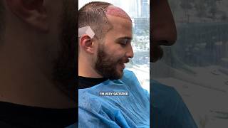 Hair Transplant Result After 8 Months - My Hair Transplant Experience