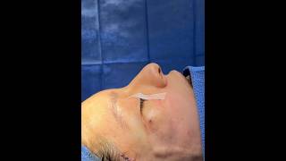 Stunning Rhinoplasty Results - Fresh Off The Table