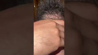 Ingrown hair tow