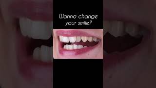 CROWNS AND VENEERS BEFORE AND AFTER | DENTAL IMPLANTS | SMILE DESIGN TURKEY | DENTIST TURKEY |