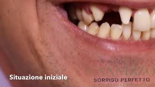 Corone in zirconio ceramica