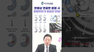 반월상 연골판 파열시 파열 위치가 중요한 이유? #반월상연골판 #파열 #shorts