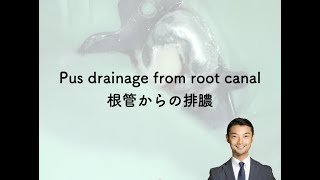 Pus drainage from Root canal system（根管からの排膿ドクドク）