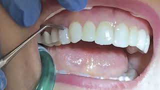 Dental Treatment Journey in Turkey  I Clinic International