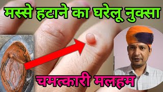 मस्से हटाने का आसान तरीका | बिना किसी सर्जरी के