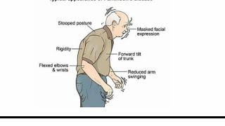 Main Symptoms in Parkinson | Parkinson  Disease-Trick #shorts