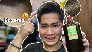 ECZEMA | EFFECTIVE PANG TANGGAL ECZEMA SA ANIT ✨ PANGPAKAL DIN NG BUHOK!❤️