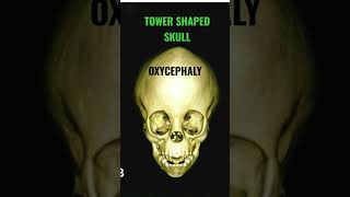 Oxycephaly