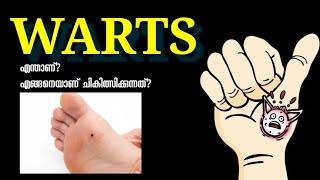 WARTS  എന്താണ്?എങ്ങനെയാണ് ചികിത്സിക്കുന്നത്?DR KHALEEL VLOG