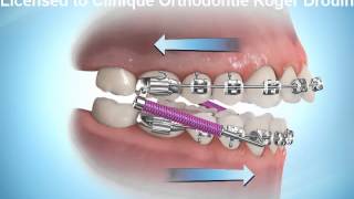 Correction de malocclusion avec ressorts