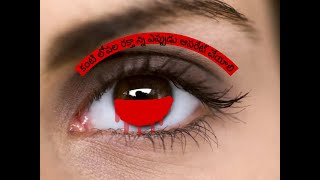 కంటి లోపల రక్తాన్ని ఎప్పుడు ఆపరేట్ చేయాలి/ When to operate blood inside the eye/ #bloodclot