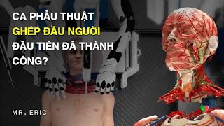 Ca phẫu thuật ghép đầu người đầu tiên đã thành công?