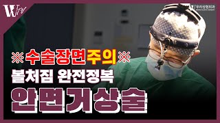 안면거상술 볼처짐 완전 정복