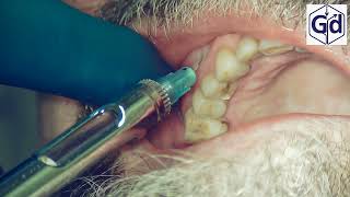 Infiltration Anesthesia for treatment  tooth  24