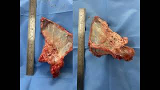 Osteoarticular reconstruction for Bone tumors Scapula tumor with ECRT: Extracorporeal radiotherapy