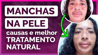 Top razões da sua pele ter manchas e melhores Óleos Essenciais para tratar