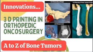 3 D Printing in Orthopedic Cancer Surgery