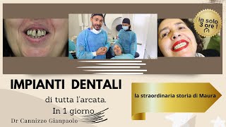 Un caso di implantologia dentale a carico immediato - Studio Dentistico Cannizzo